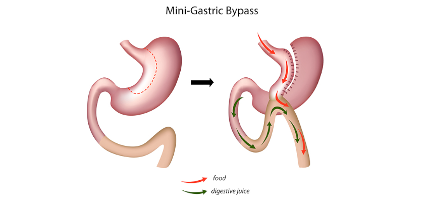 mini gastric bypass 840x400 1