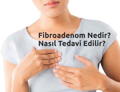Fibroadenom Nedir? Nasıl Tedavi Edilir?